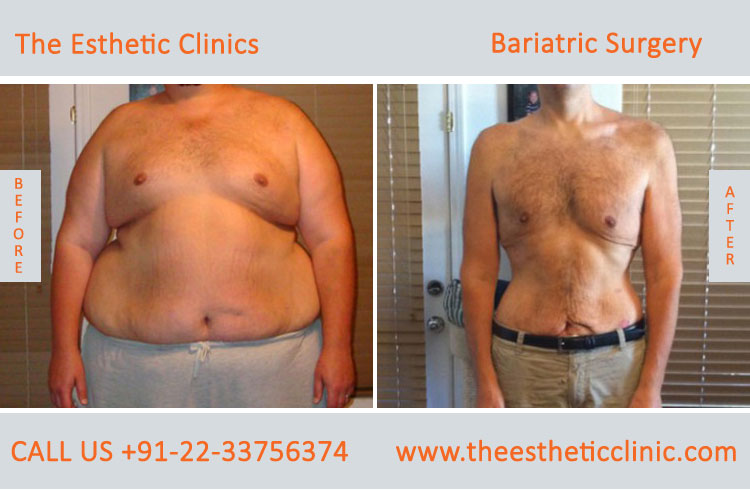 Bariatric Surgery, Weight Loss Surgery before after photos in mumbai india (4)